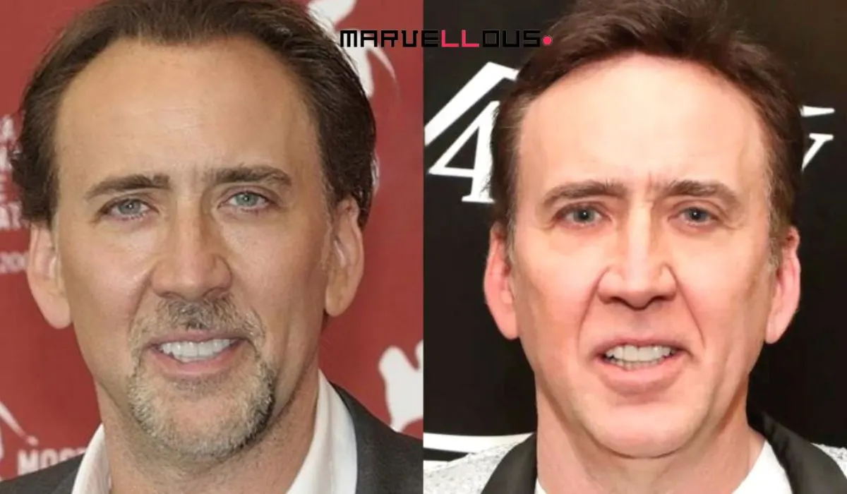 Celebrity Hair Transplants Before And After Celebrity Hair Transplants Before And After